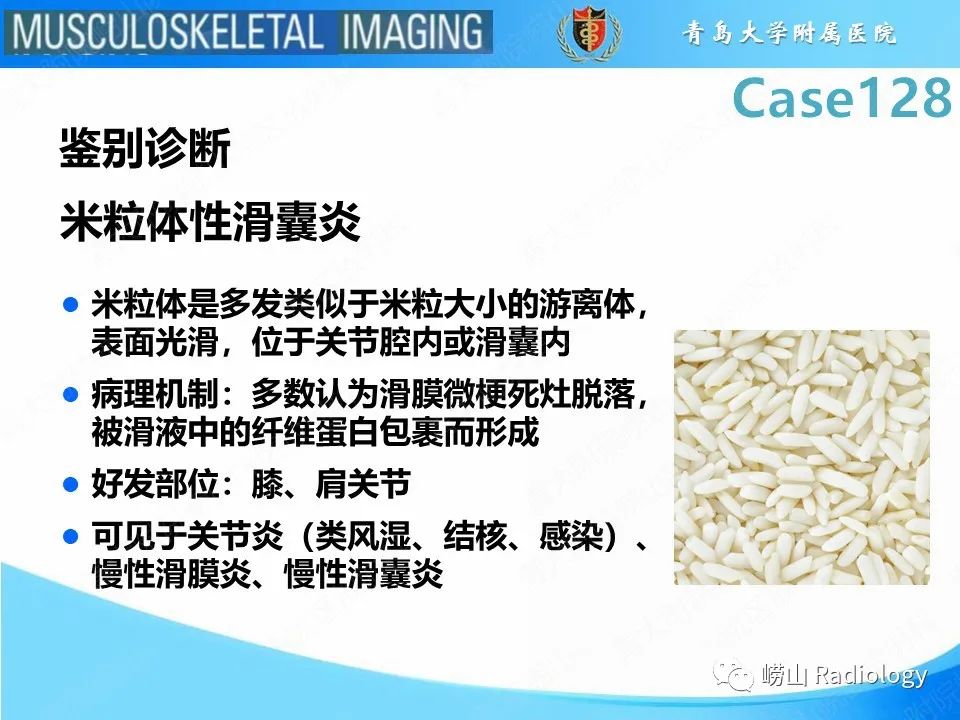 影像PPT - 【PPT】滑膜骨软骨瘤病-19