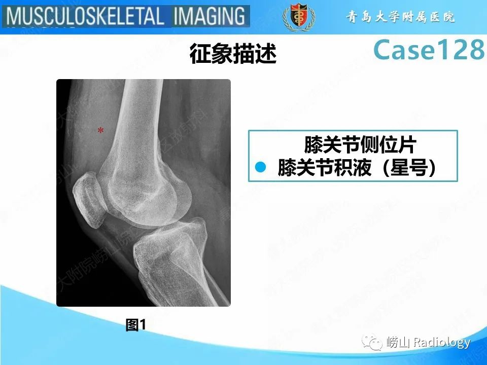 影像PPT - 【PPT】滑膜骨软骨瘤病-11