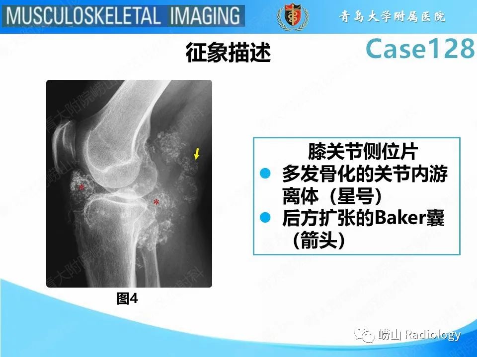 影像PPT - 【PPT】滑膜骨软骨瘤病-14