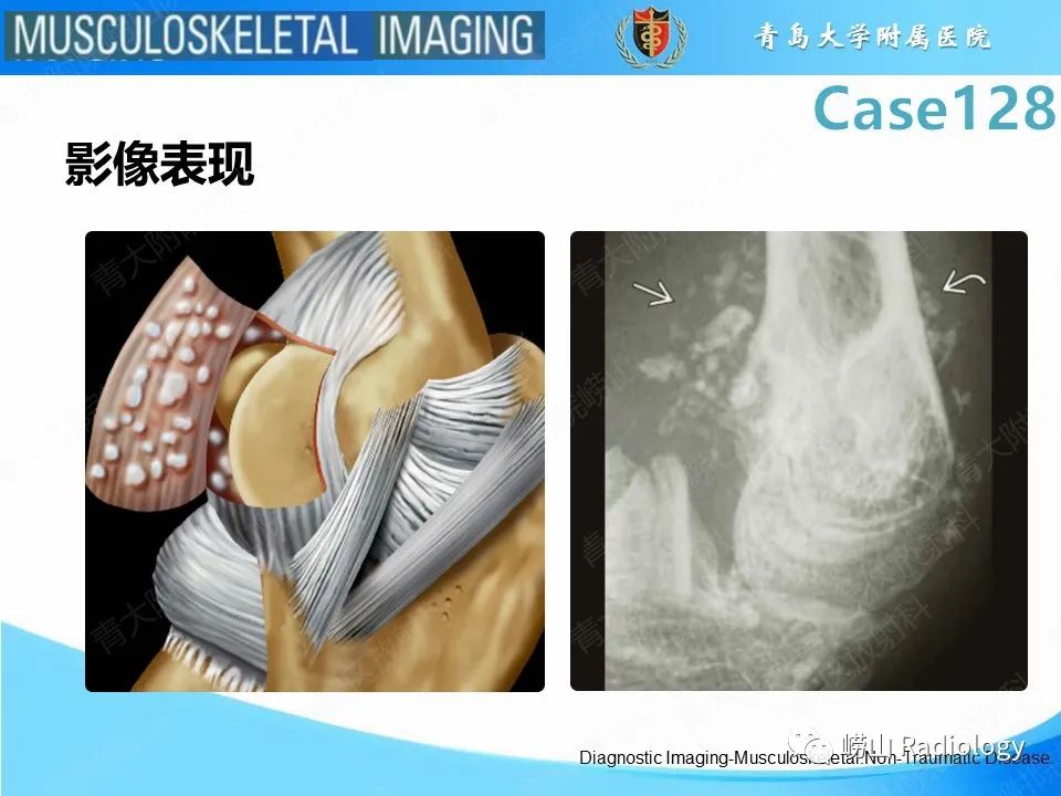 影像PPT - 【PPT】滑膜骨软骨瘤病-17