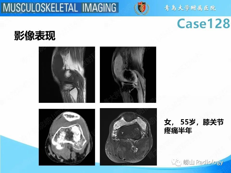 影像PPT - 【PPT】滑膜骨软骨瘤病-21