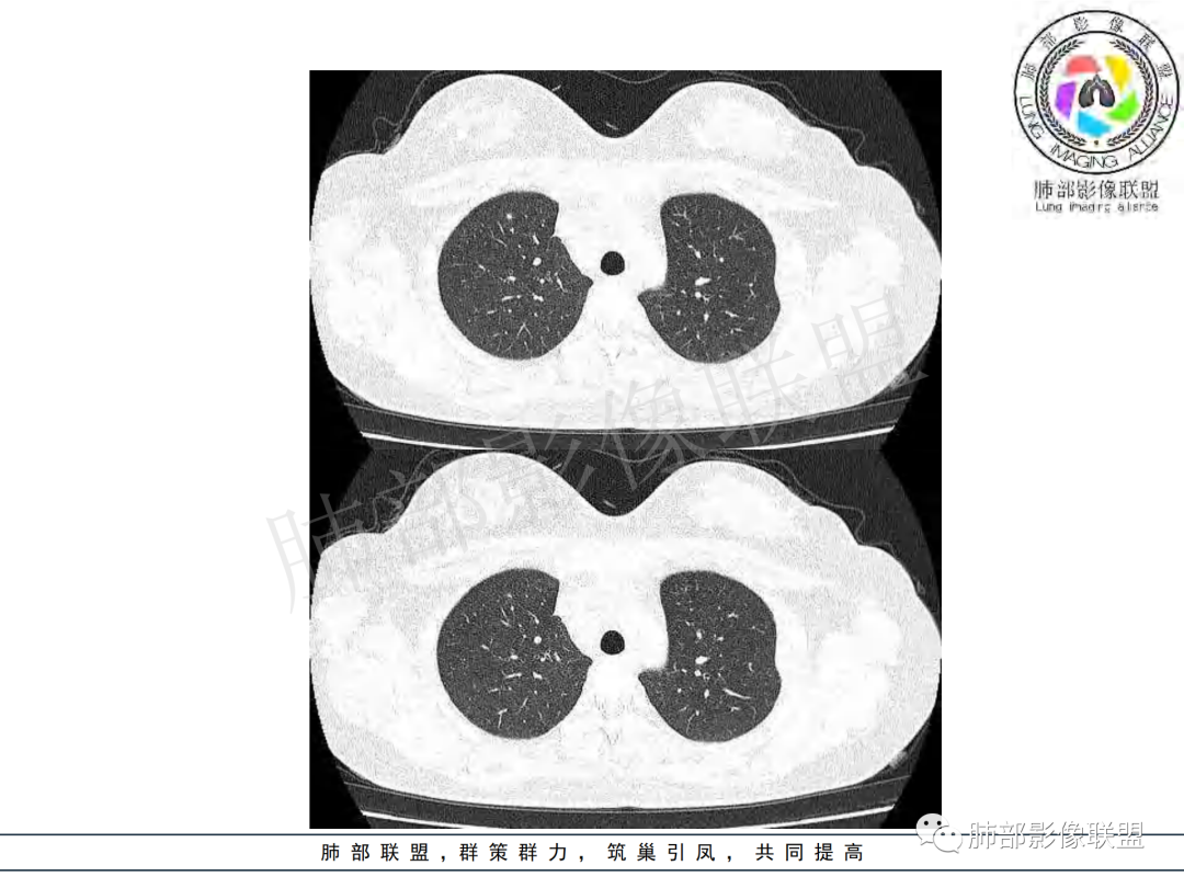 影像PPT - 【病例】年龄与环形强化可大致锁定病原体-7 影像PPT - 【病例】年龄与环形强化可大致锁定病原体-7