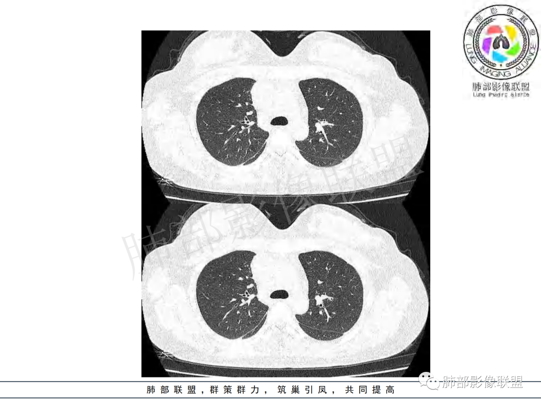 影像PPT - 【病例】年龄与环形强化可大致锁定病原体-15 影像PPT - 【病例】年龄与环形强化可大致锁定病原体-15
