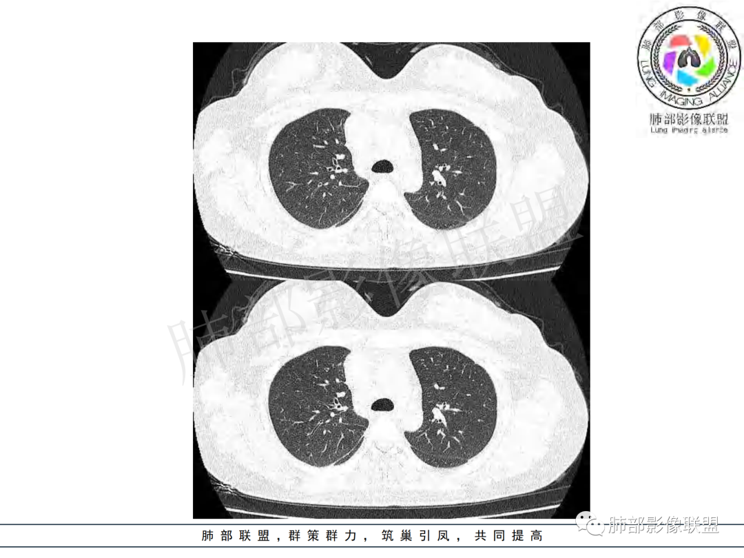 影像PPT - 【病例】年龄与环形强化可大致锁定病原体-14 影像PPT - 【病例】年龄与环形强化可大致锁定病原体-14