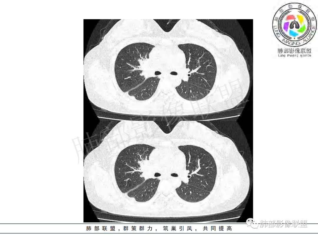 影像PPT - 【病例】年龄与环形强化可大致锁定病原体-25 影像PPT - 【病例】年龄与环形强化可大致锁定病原体-25