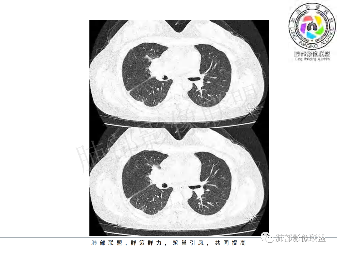 影像PPT - 【病例】年龄与环形强化可大致锁定病原体-30 影像PPT - 【病例】年龄与环形强化可大致锁定病原体-30