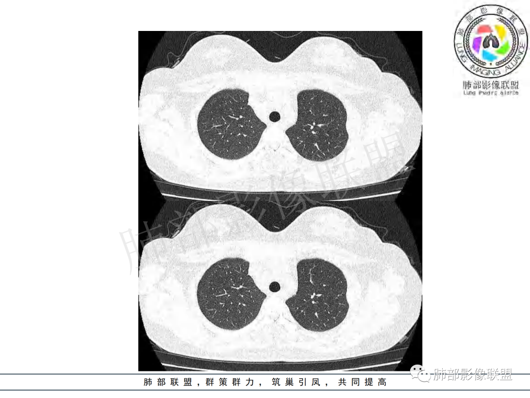影像PPT - 【病例】年龄与环形强化可大致锁定病原体-5 影像PPT - 【病例】年龄与环形强化可大致锁定病原体-5