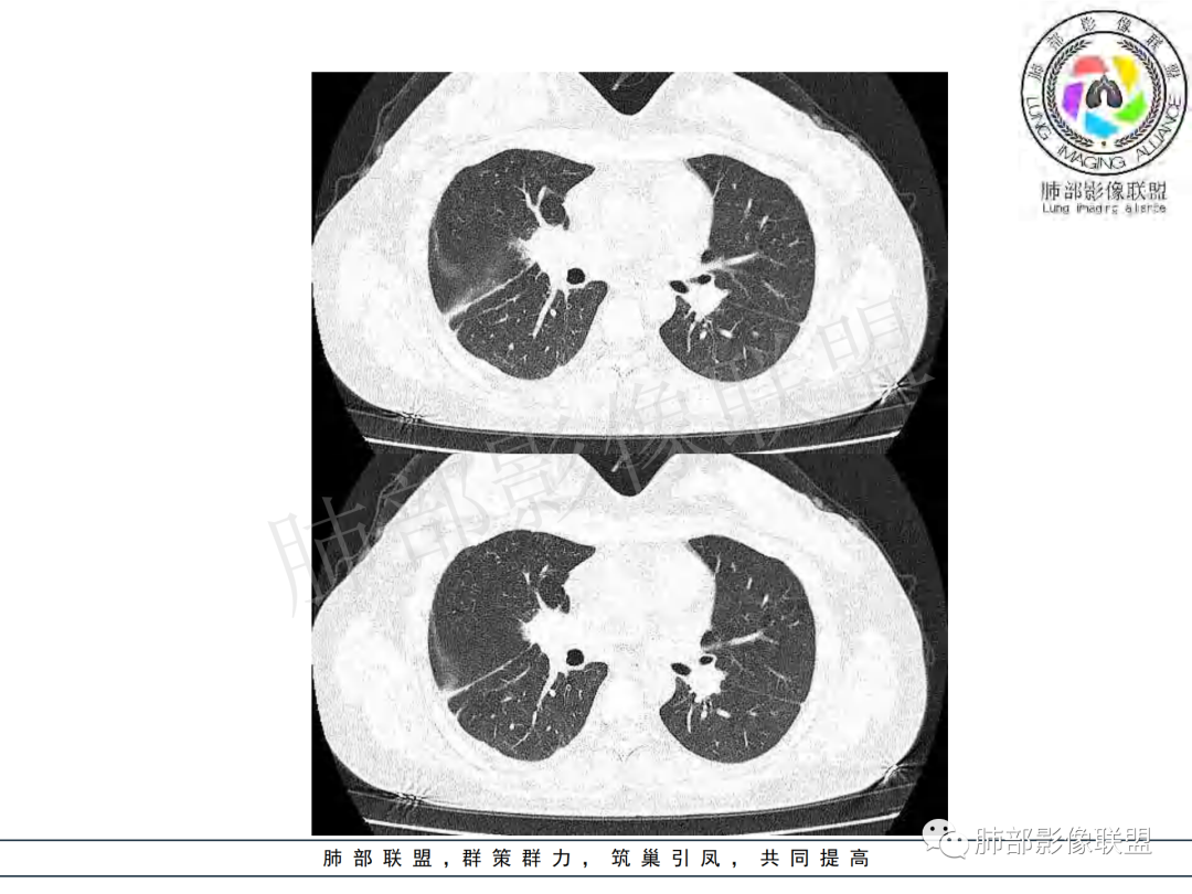 影像PPT - 【病例】年龄与环形强化可大致锁定病原体-32 影像PPT - 【病例】年龄与环形强化可大致锁定病原体-32