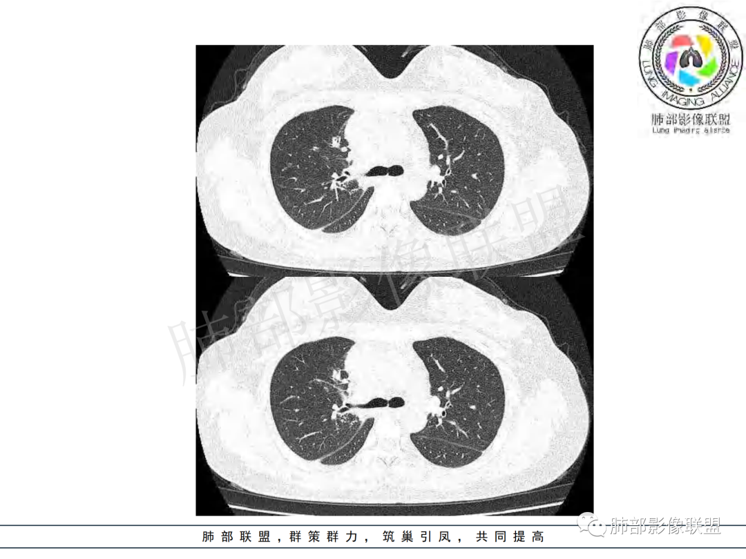 影像PPT - 【病例】年龄与环形强化可大致锁定病原体-19 影像PPT - 【病例】年龄与环形强化可大致锁定病原体-19