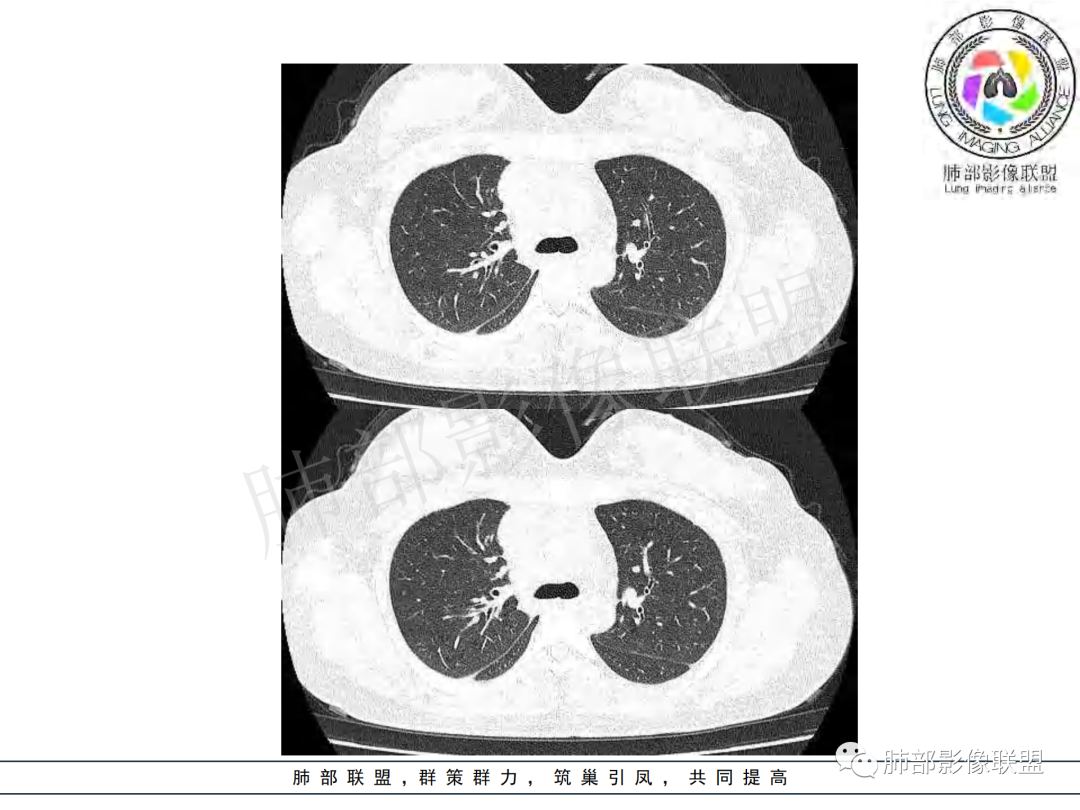 影像PPT - 【病例】年龄与环形强化可大致锁定病原体-17 影像PPT - 【病例】年龄与环形强化可大致锁定病原体-17