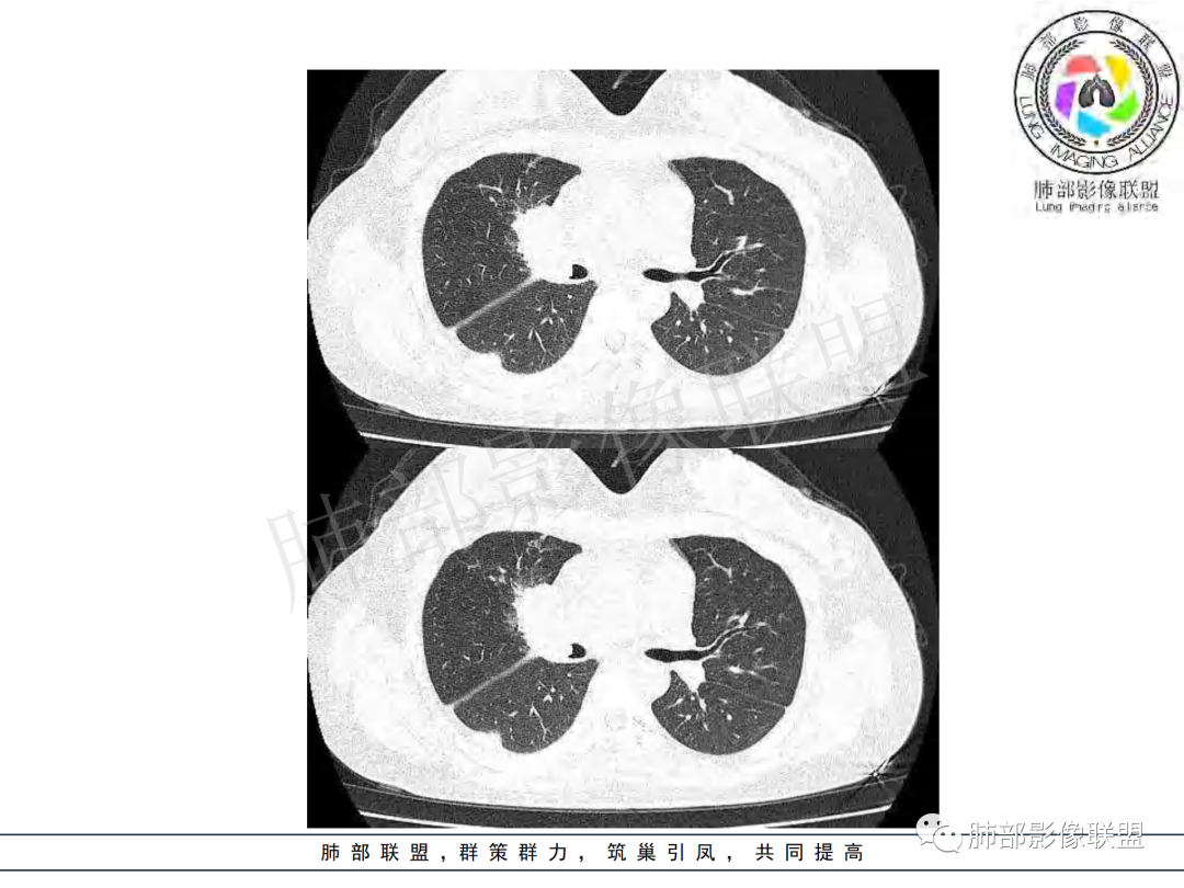 影像PPT - 【病例】年龄与环形强化可大致锁定病原体-28 影像PPT - 【病例】年龄与环形强化可大致锁定病原体-28