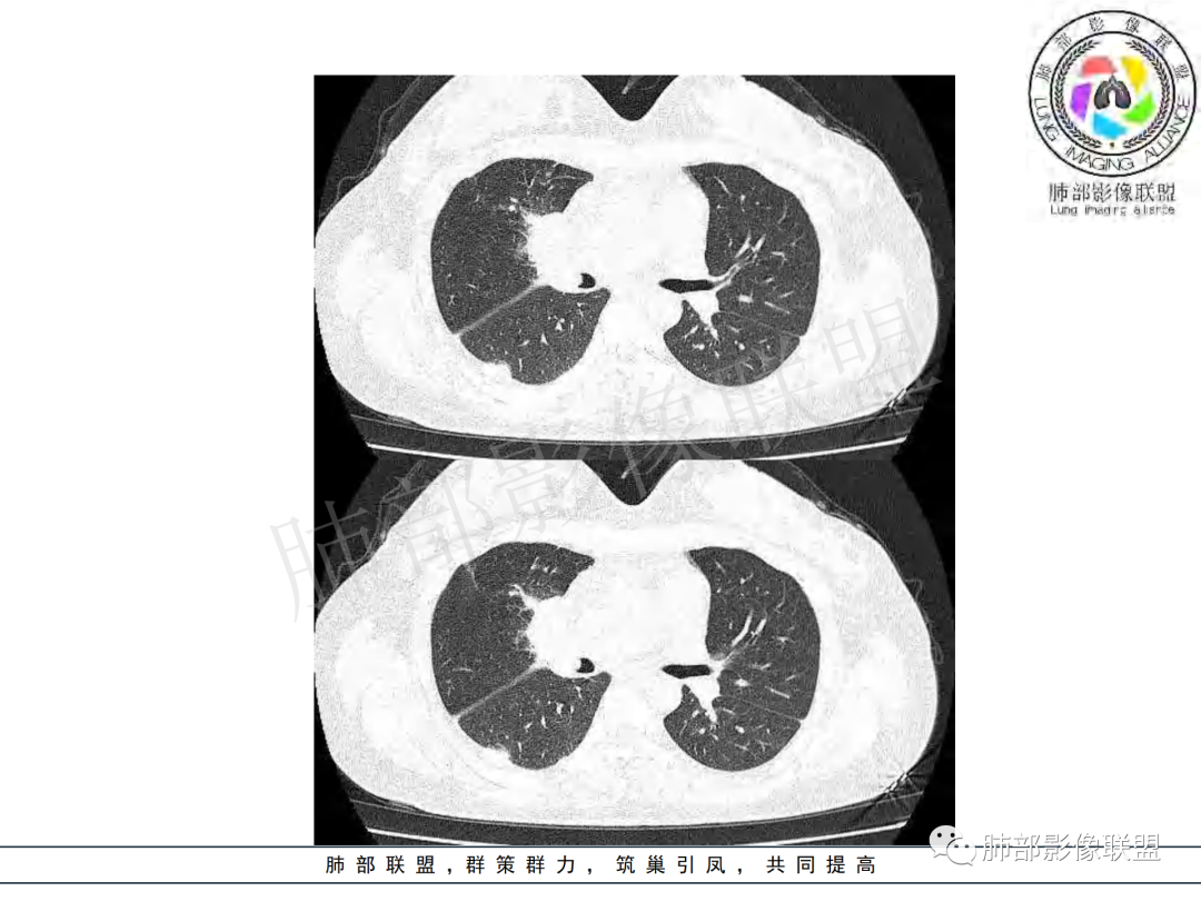 影像PPT - 【病例】年龄与环形强化可大致锁定病原体-29 影像PPT - 【病例】年龄与环形强化可大致锁定病原体-29