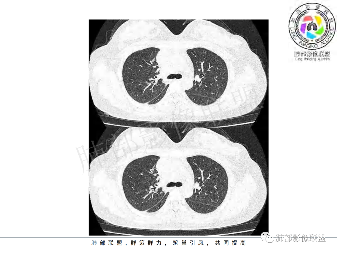 影像PPT - 【病例】年龄与环形强化可大致锁定病原体-18 影像PPT - 【病例】年龄与环形强化可大致锁定病原体-18