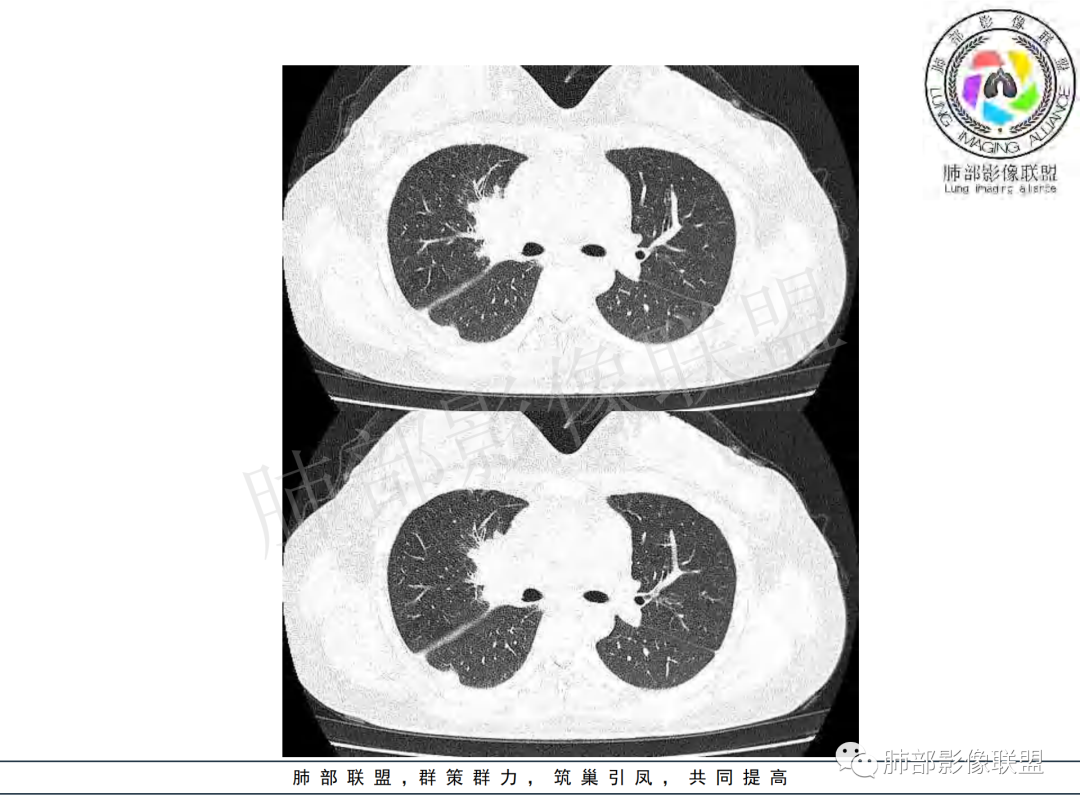 影像PPT - 【病例】年龄与环形强化可大致锁定病原体-26 影像PPT - 【病例】年龄与环形强化可大致锁定病原体-26