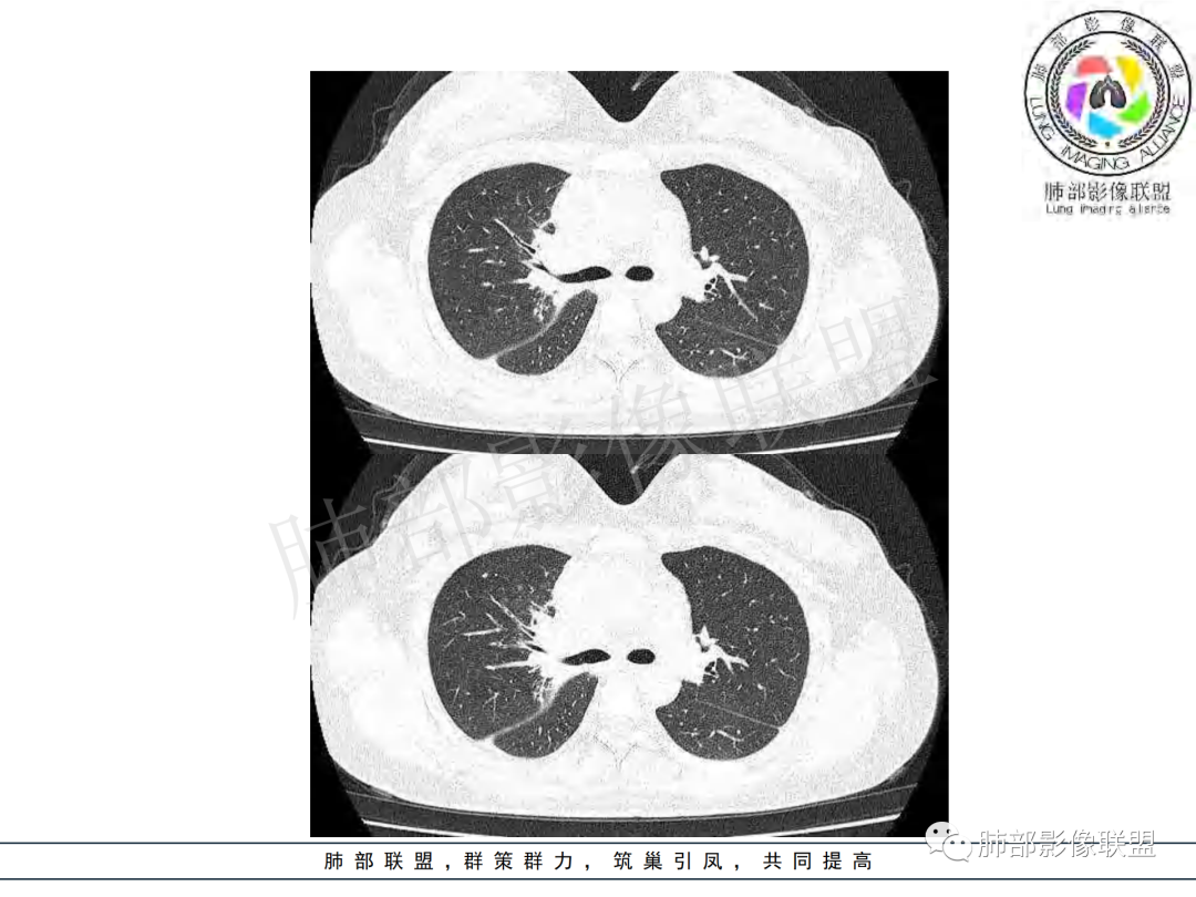 影像PPT - 【病例】年龄与环形强化可大致锁定病原体-22 影像PPT - 【病例】年龄与环形强化可大致锁定病原体-22