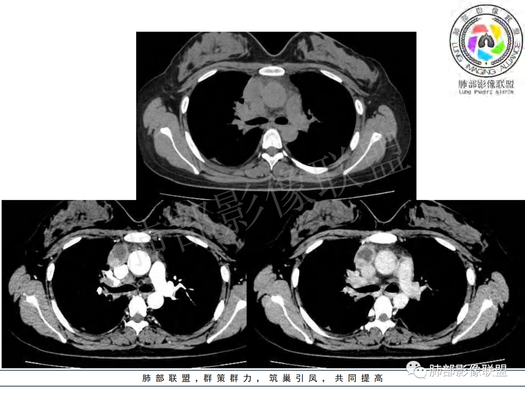 影像PPT - 【病例】年龄与环形强化可大致锁定病原体-57 影像PPT - 【病例】年龄与环形强化可大致锁定病原体-57