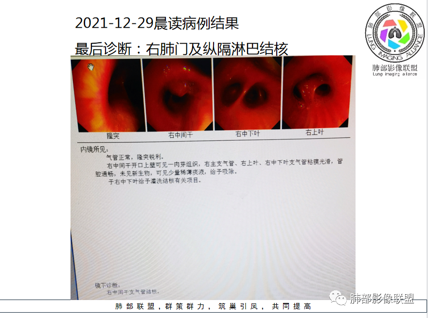 影像PPT - 【病例】年龄与环形强化可大致锁定病原体-67 影像PPT - 【病例】年龄与环形强化可大致锁定病原体-67