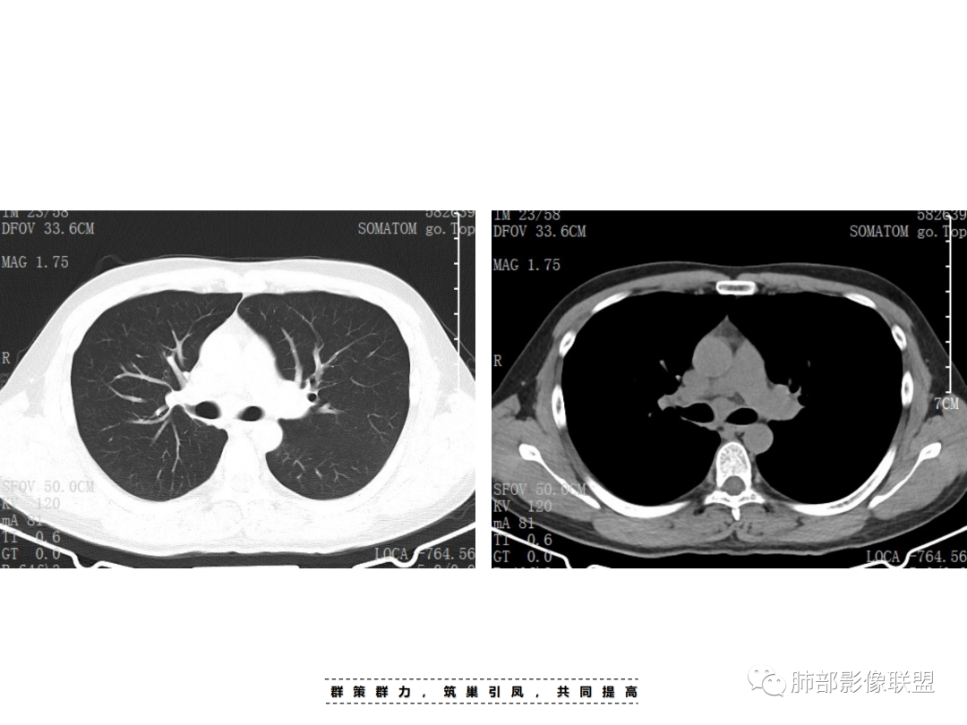 影像PPT - 【病例】 认识罕见的肺NUT癌-3 影像PPT - 【病例】 认识罕见的肺NUT癌-3