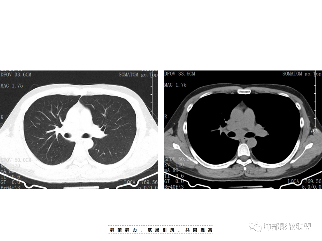 影像PPT - 【病例】 认识罕见的肺NUT癌-4 影像PPT - 【病例】 认识罕见的肺NUT癌-4