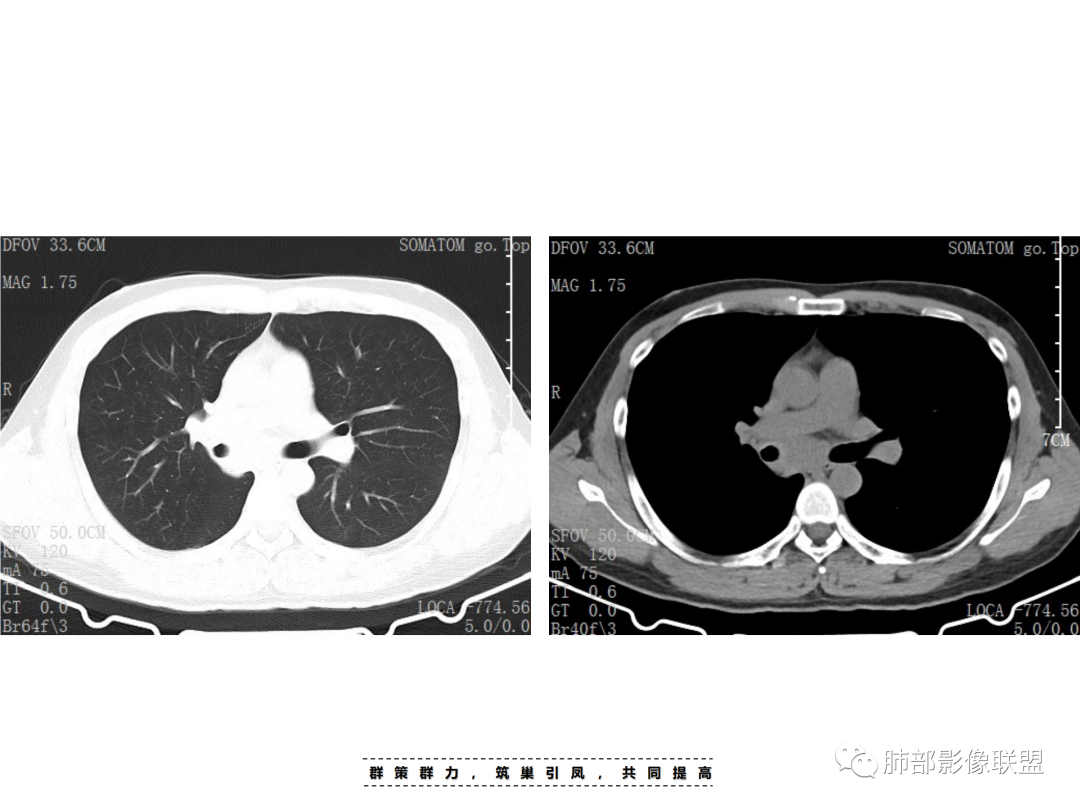 影像PPT - 【病例】 认识罕见的肺NUT癌-5 影像PPT - 【病例】 认识罕见的肺NUT癌-5