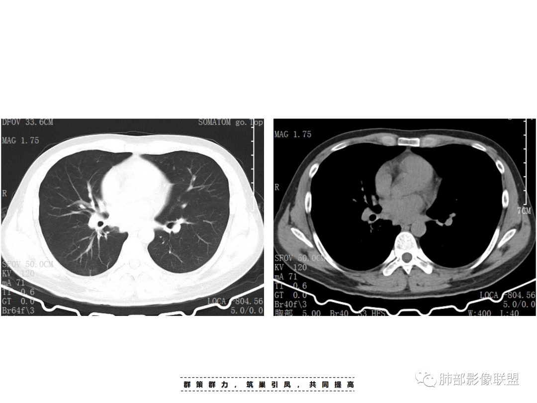 影像PPT - 【病例】 认识罕见的肺NUT癌-11 影像PPT - 【病例】 认识罕见的肺NUT癌-11