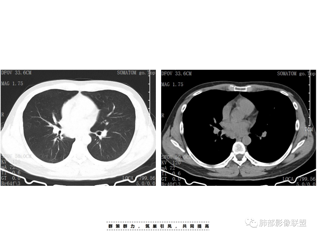 影像PPT - 【病例】 认识罕见的肺NUT癌-10 影像PPT - 【病例】 认识罕见的肺NUT癌-10