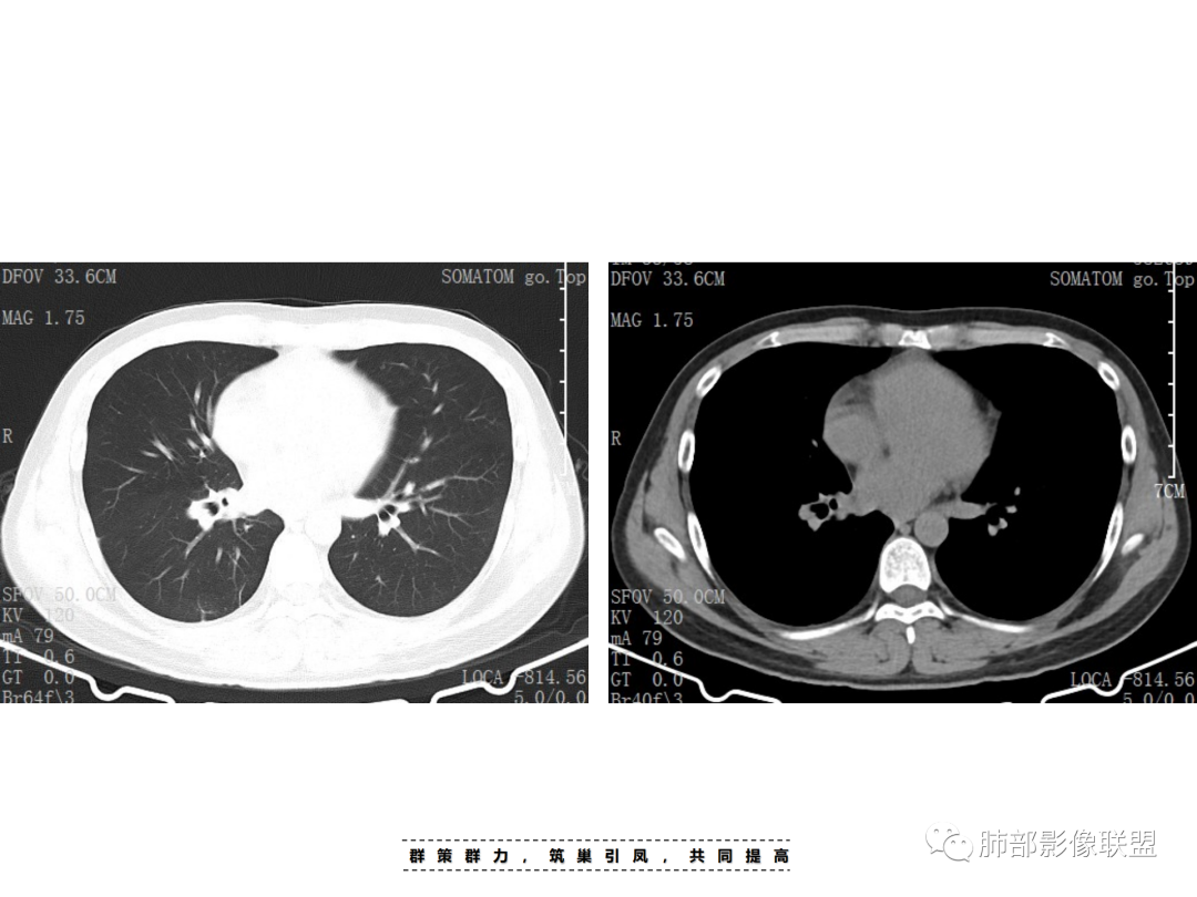 影像PPT - 【病例】 认识罕见的肺NUT癌-13 影像PPT - 【病例】 认识罕见的肺NUT癌-13