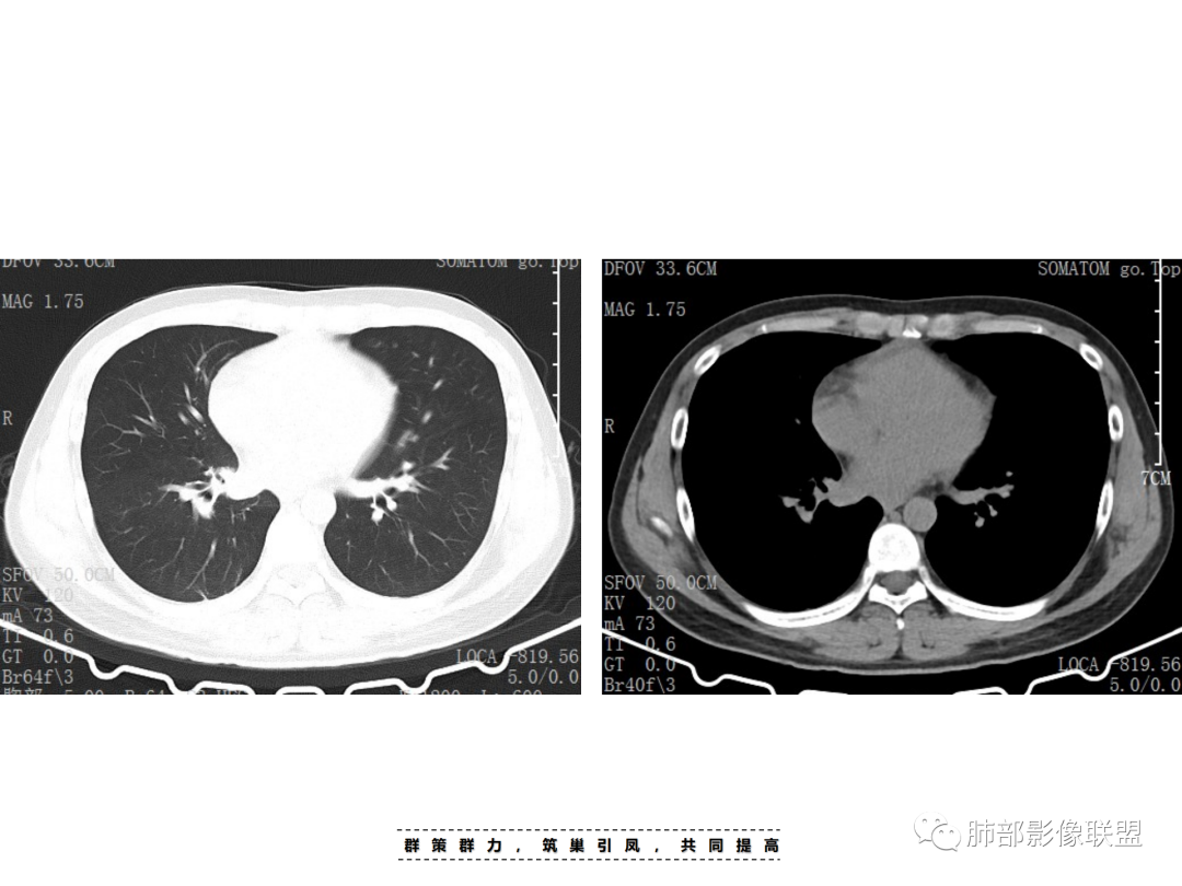 影像PPT - 【病例】 认识罕见的肺NUT癌-14 影像PPT - 【病例】 认识罕见的肺NUT癌-14