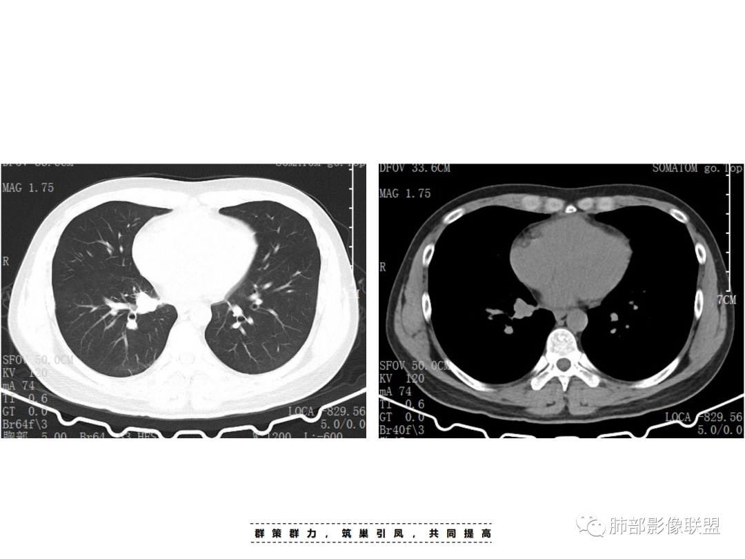 影像PPT - 【病例】 认识罕见的肺NUT癌-16 影像PPT - 【病例】 认识罕见的肺NUT癌-16