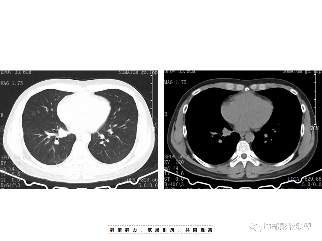 影像PPT - 【病例】 认识罕见的肺NUT癌-17 影像PPT - 【病例】 认识罕见的肺NUT癌-17