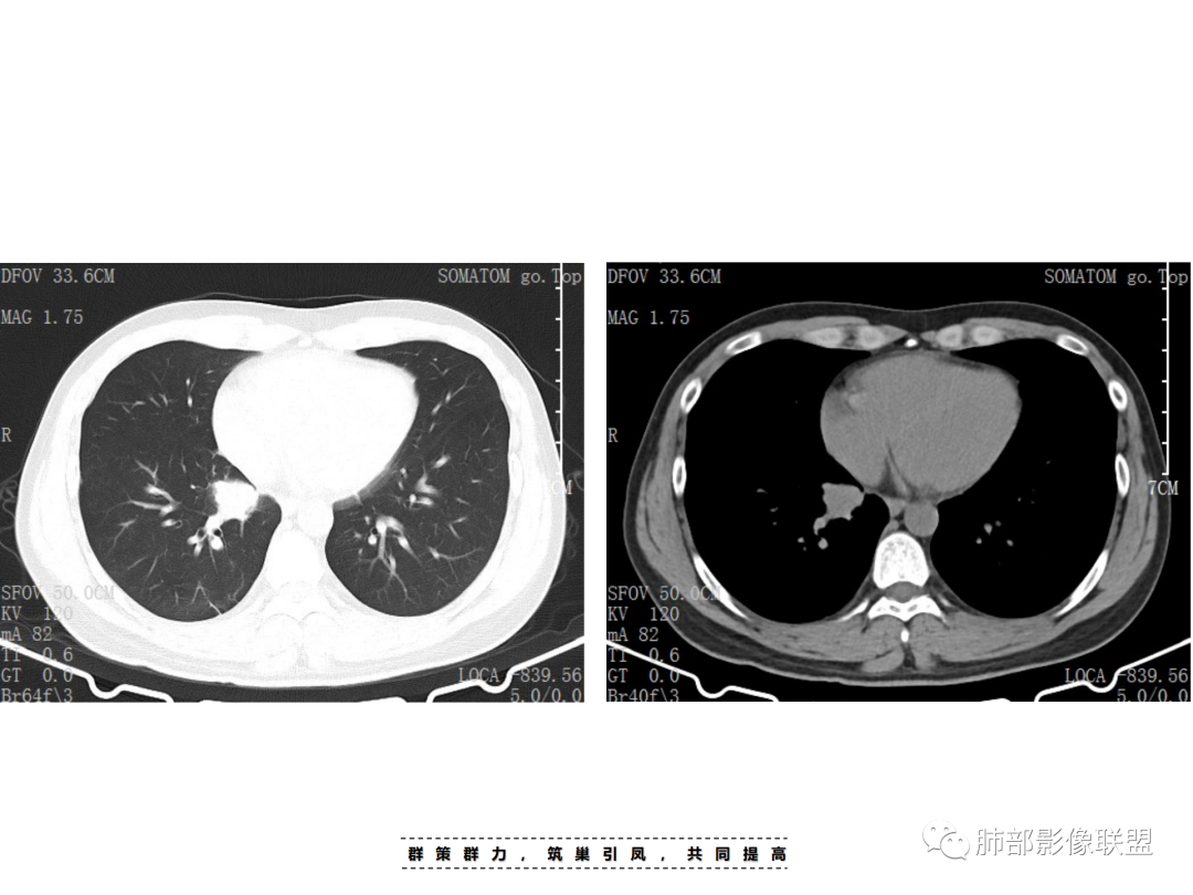 影像PPT - 【病例】 认识罕见的肺NUT癌-19 影像PPT - 【病例】 认识罕见的肺NUT癌-19