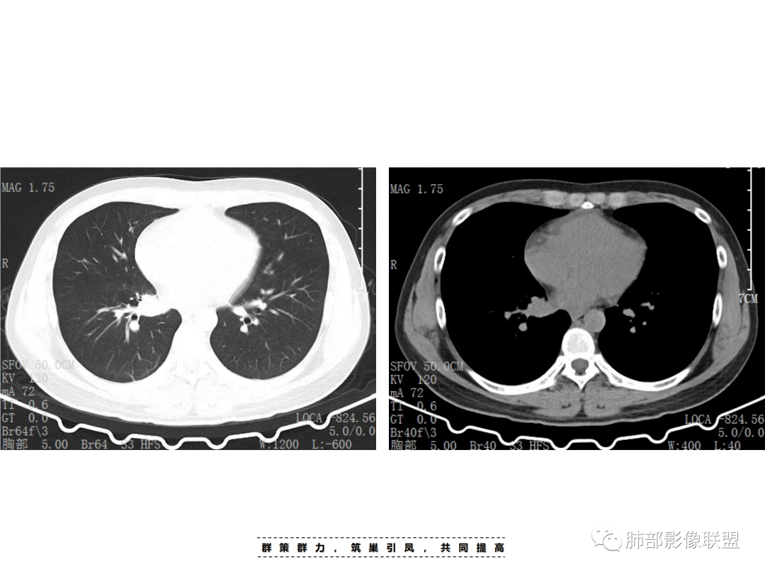 影像PPT - 【病例】 认识罕见的肺NUT癌-15 影像PPT - 【病例】 认识罕见的肺NUT癌-15