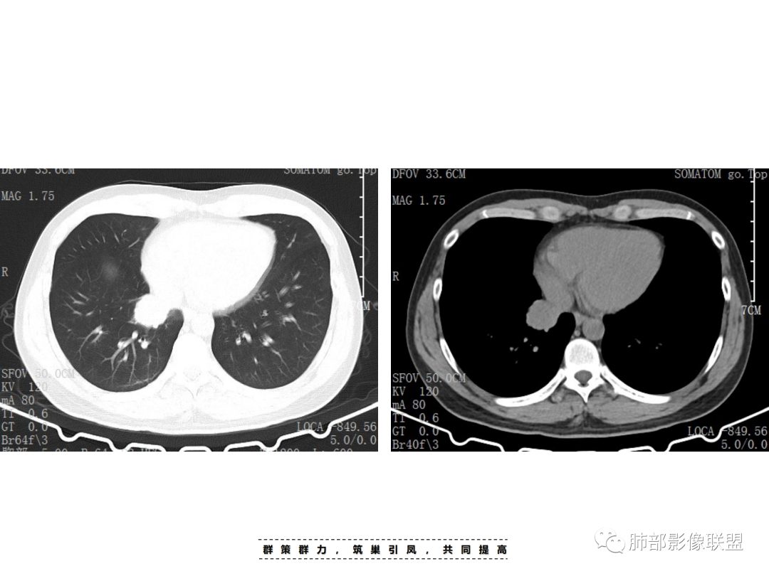 影像PPT - 【病例】 认识罕见的肺NUT癌-21 影像PPT - 【病例】 认识罕见的肺NUT癌-21