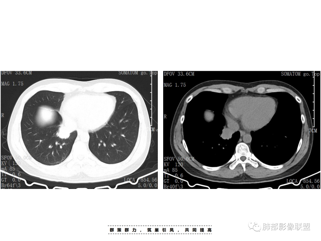 影像PPT - 【病例】 认识罕见的肺NUT癌-22 影像PPT - 【病例】 认识罕见的肺NUT癌-22