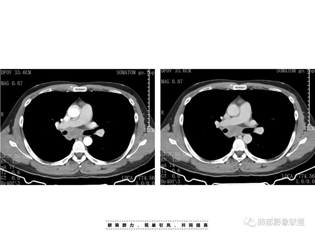 影像PPT - 【病例】 认识罕见的肺NUT癌-26 影像PPT - 【病例】 认识罕见的肺NUT癌-26