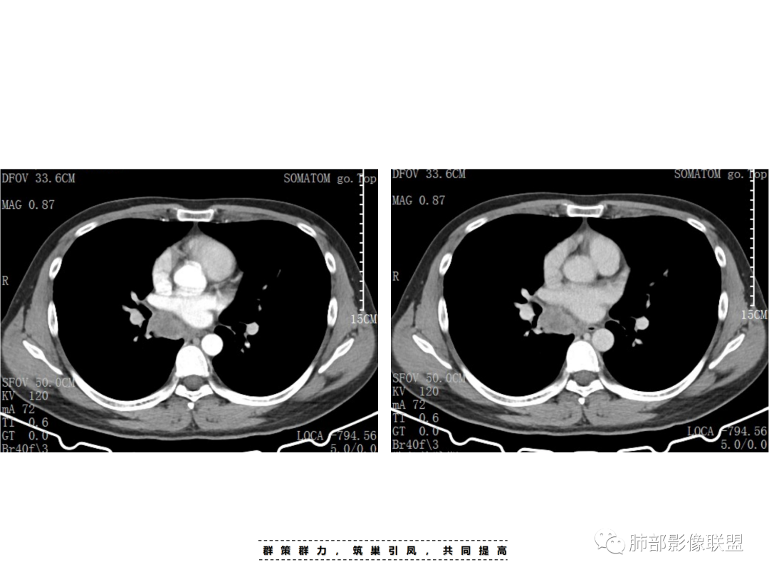 影像PPT - 【病例】 认识罕见的肺NUT癌-30 影像PPT - 【病例】 认识罕见的肺NUT癌-30
