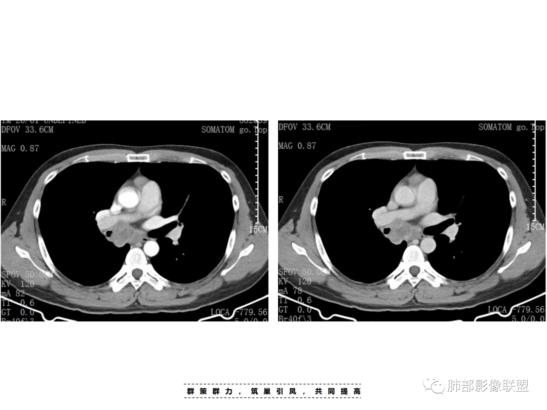 影像PPT - 【病例】 认识罕见的肺NUT癌-27 影像PPT - 【病例】 认识罕见的肺NUT癌-27