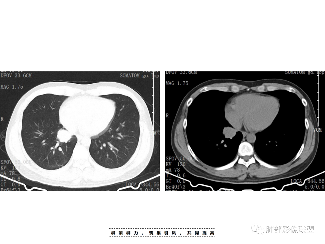影像PPT - 【病例】 认识罕见的肺NUT癌-20 影像PPT - 【病例】 认识罕见的肺NUT癌-20