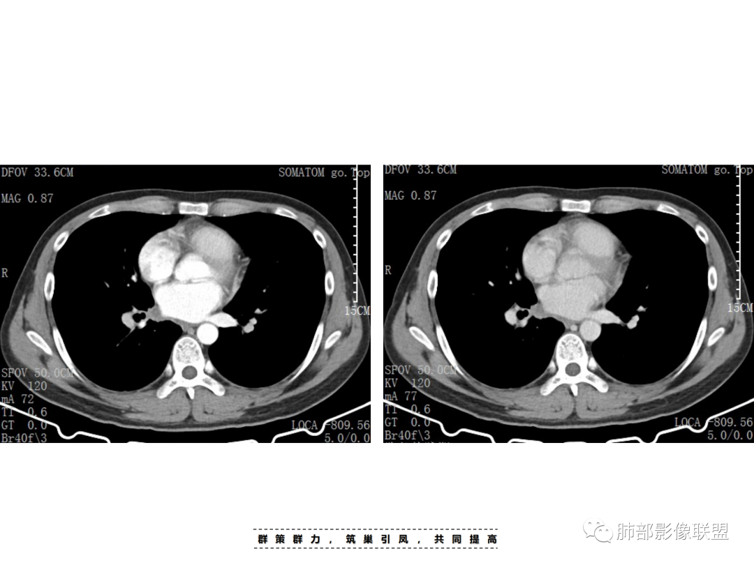 影像PPT - 【病例】 认识罕见的肺NUT癌-33 影像PPT - 【病例】 认识罕见的肺NUT癌-33