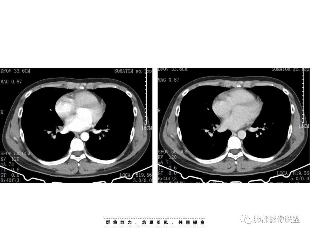 影像PPT - 【病例】 认识罕见的肺NUT癌-35 影像PPT - 【病例】 认识罕见的肺NUT癌-35