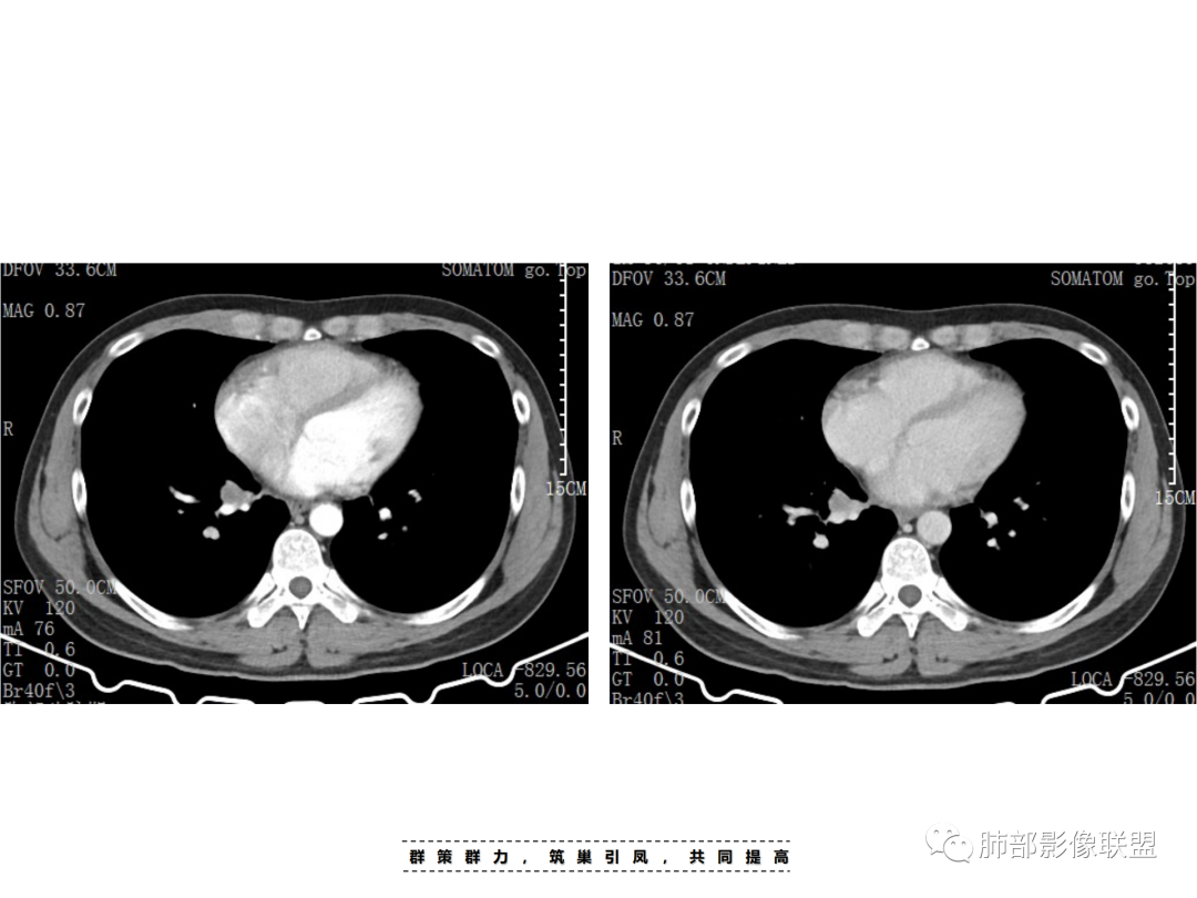 影像PPT - 【病例】 认识罕见的肺NUT癌-37 影像PPT - 【病例】 认识罕见的肺NUT癌-37