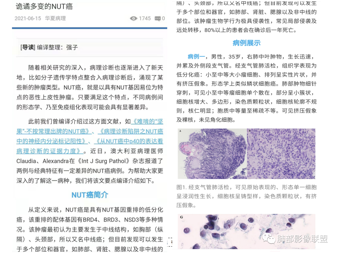 影像PPT - 【病例】 认识罕见的肺NUT癌-51 影像PPT - 【病例】 认识罕见的肺NUT癌-51