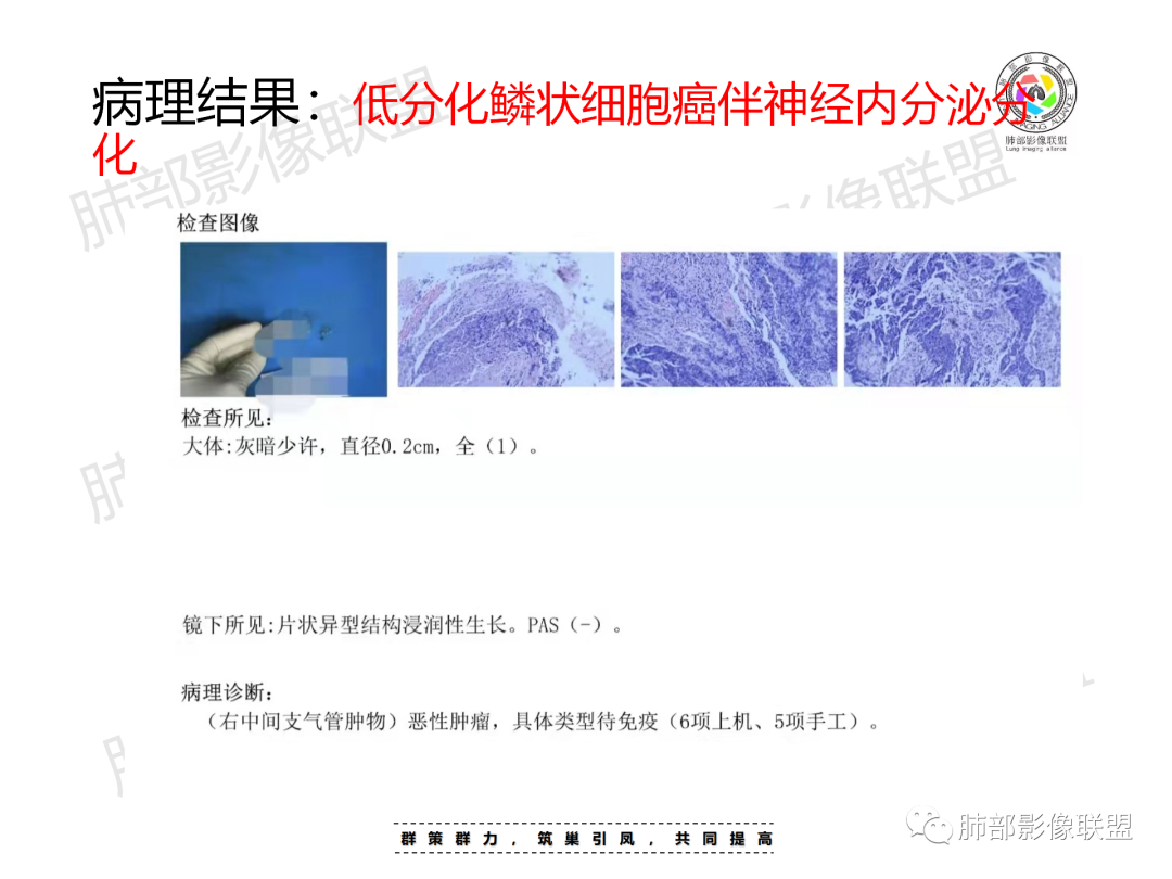 影像PPT - 【病例】 认识罕见的肺NUT癌-48 影像PPT - 【病例】 认识罕见的肺NUT癌-48