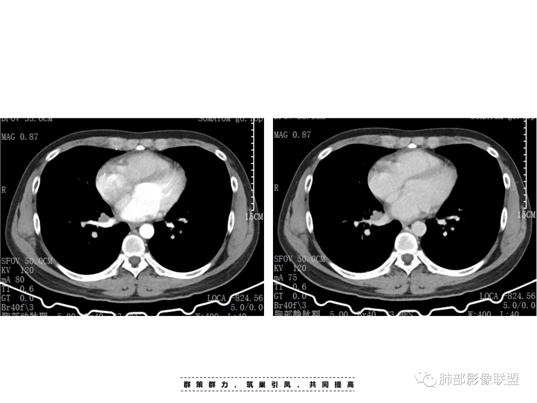 影像PPT - 【病例】 认识罕见的肺NUT癌-36 影像PPT - 【病例】 认识罕见的肺NUT癌-36