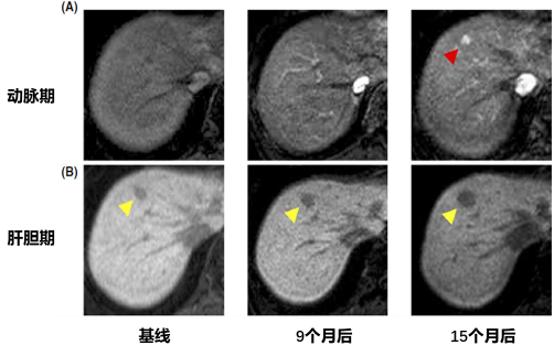 影像PPT - 专家解读丨非富血供肝胆期低信号结节(NHHNs)-2 影像PPT - 专家解读丨非富血供肝胆期低信号结节(NHHNs)-2