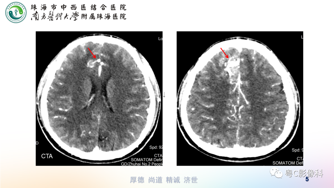 影像PPT - 【PPT】蛛网膜下腔出血-5