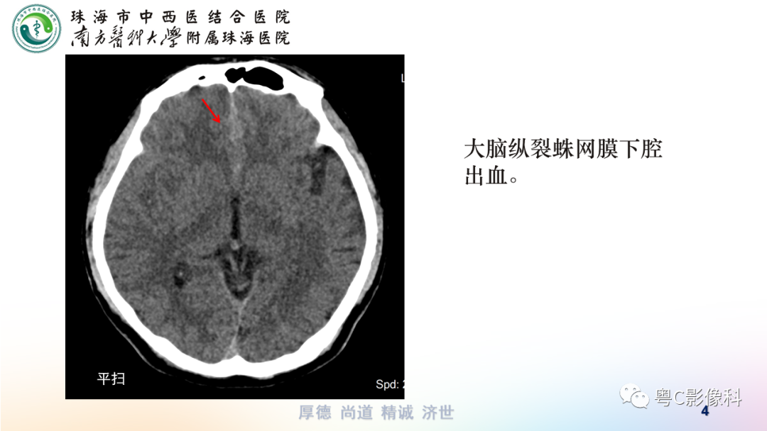 影像PPT - 【PPT】蛛网膜下腔出血-4