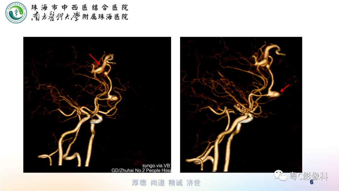 影像PPT - 【PPT】蛛网膜下腔出血-6