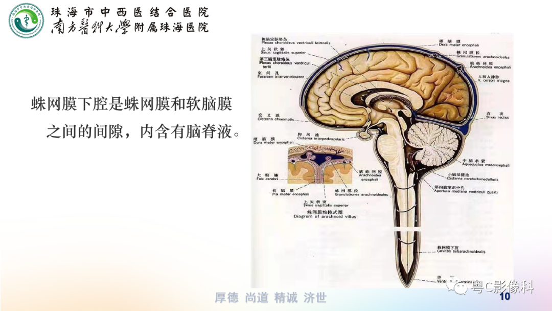 影像PPT - 【PPT】蛛网膜下腔出血-10
