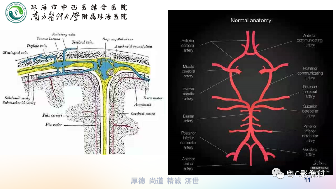 影像PPT - 【PPT】蛛网膜下腔出血-11